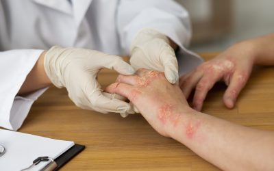 Psoriasis: Cómo Identificar, Diagnosticar y Manejar su Impacto en la Calidad de Vida